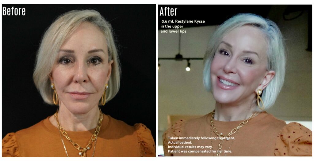 Sheree Frede of the SheSheShow profile photo before and after lip filler